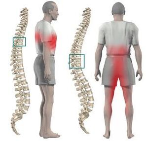 Ana iya ba da ciwo tare da thoracic chondrosis zuwa ƙananan yatsar hannu da crotch