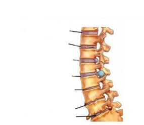 Bayyanar cututtuka na osteochondrosis