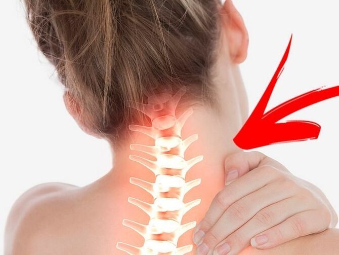 Matsawa na jijiya Tushen tare da ervical osteochondrosis