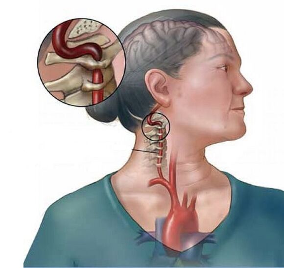 Syndraly Artery Syndrome tare da Kertical Osteochondrosis