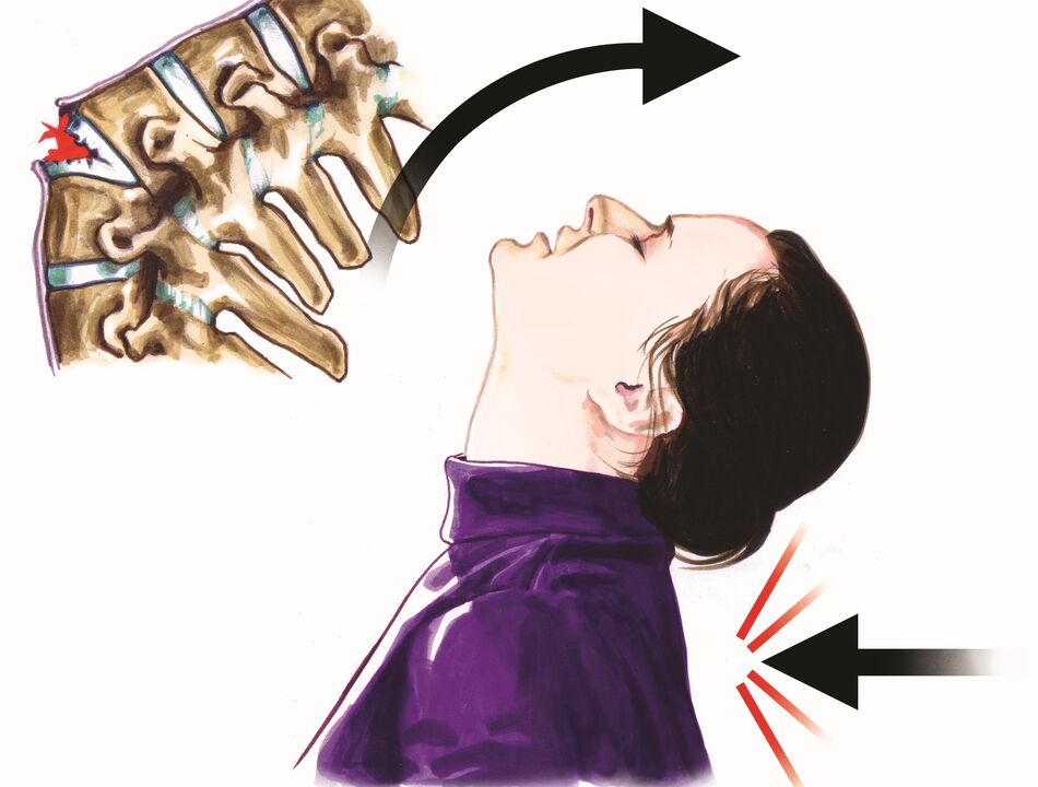 lalacewar kashin baya a matsayin dalilin ciwon wuyansa